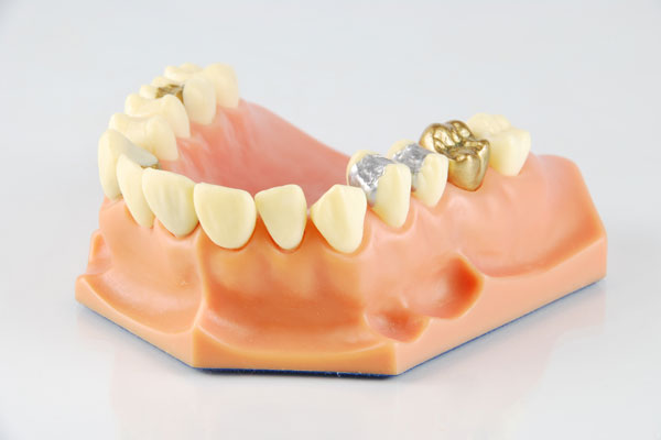 Cyprus dental inlay onlay